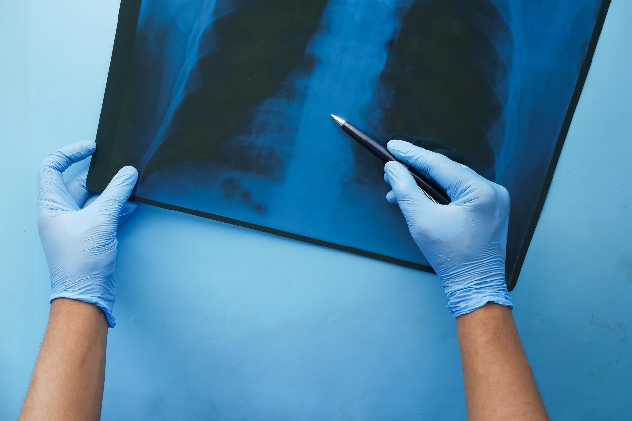 Tuberkulose und die BCG-Impfung